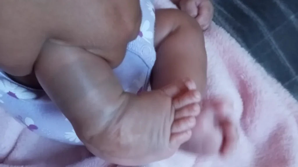 Mãe luta contra o tempo para tratar pé torto de filha após parto