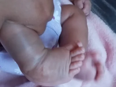 Mãe luta contra o tempo para tratar pé torto de filha após parto